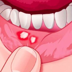 [Nhiệt miệng, loét miệng, lở miệng] Cách điều trị và phòng tránh nhiệt miệng