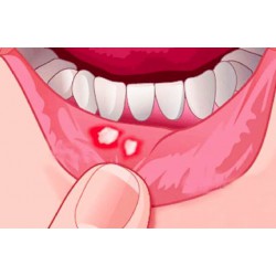 [Nhiệt miệng, loét miệng, lở miệng] Cách điều trị và phòng tránh nhiệt miệng