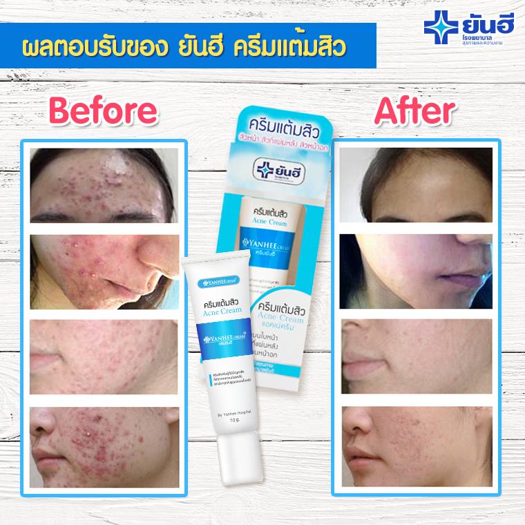 yanhee%20acne%20thailand