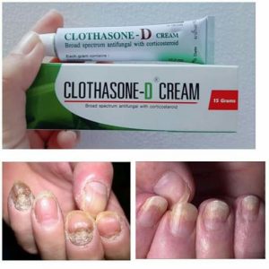 Kem Trị Nấm Móng Tay Móng Chân Clothasone-D Cream 15g Thái Lan